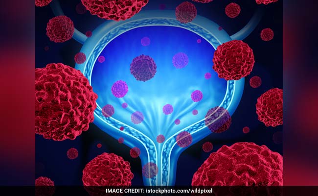 Blood In Urine May Indicate Prostate Cancer, 10 Early ...