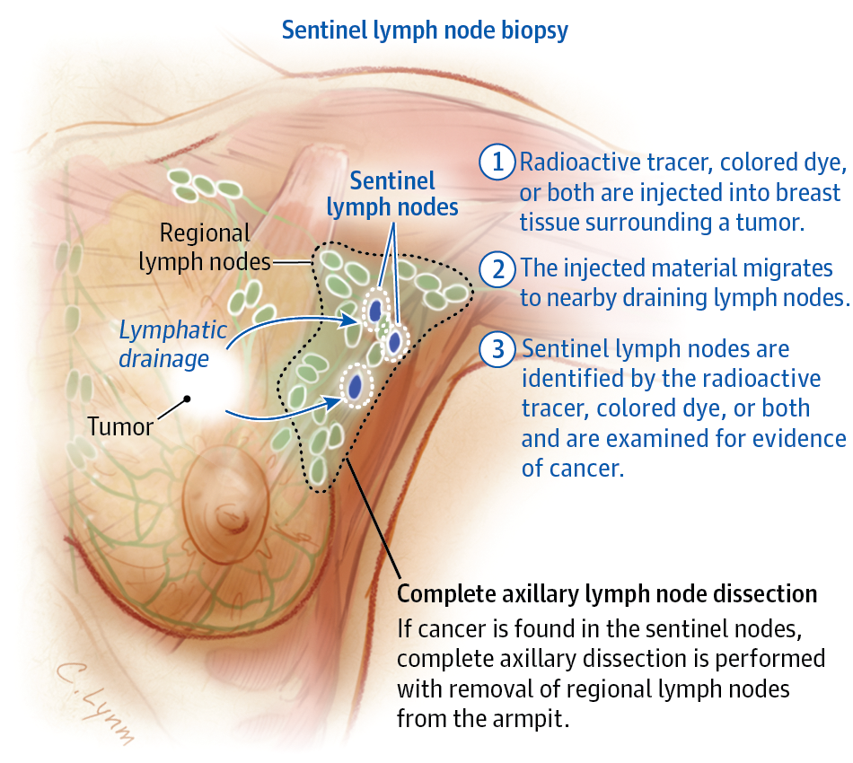 Breast Cancer and Axillary Lymph Nodes.