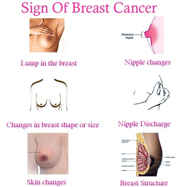 Breast Cancer Pictures: Sign Of Breast Cancer