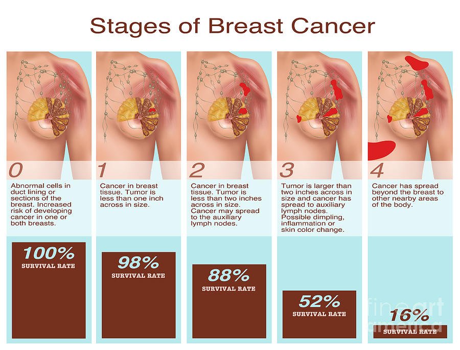 Breast Cancer Stages, Illustration Photograph by Gwen Shockey