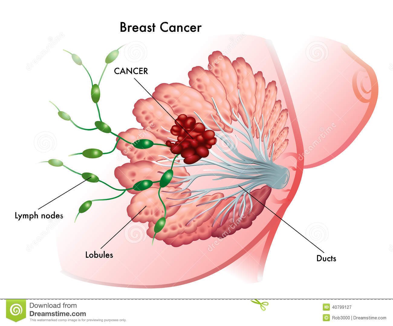 Breast Cancer stock vector. Illustration of cribriform ...