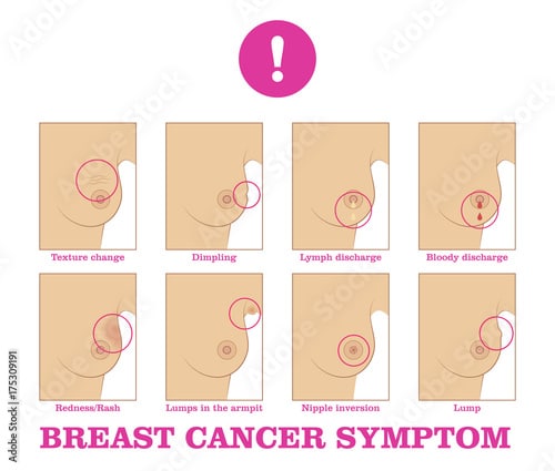 Breast cancer symptom. Warning signs and danger, unusual changes and ...