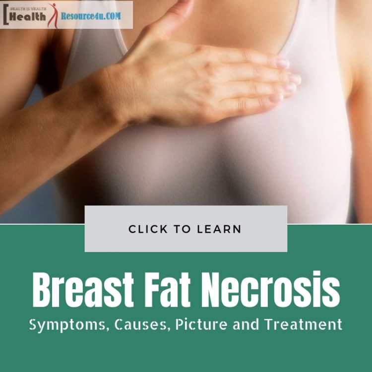 Breast Fat Necrosis: Symptoms, Causes, Picture and Treatments