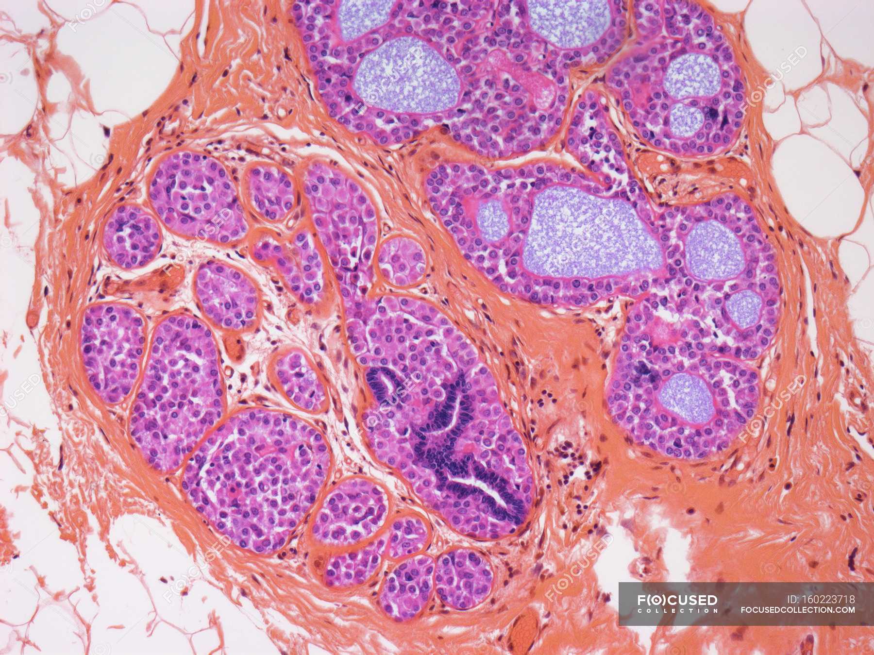 Breast with lobular carcinoma  lobular neoplasia, physiology