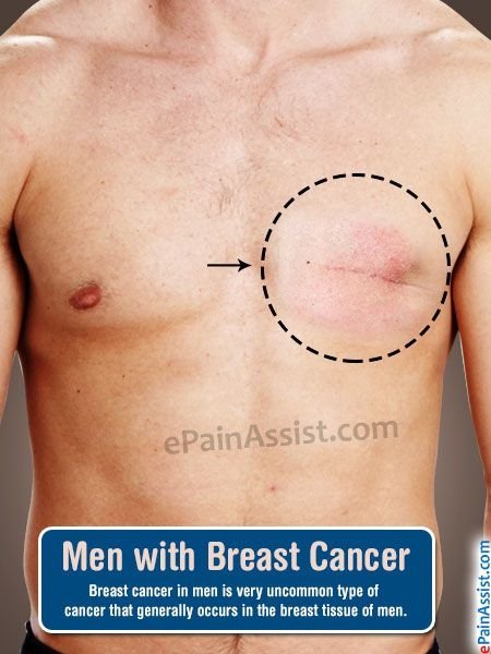 Brest Cancer In Men