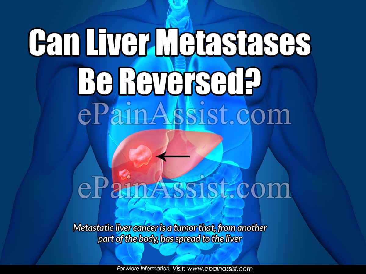 Can Liver Metastases be Reversed?