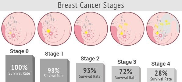 Can stage 3rd breast cancer be cured?