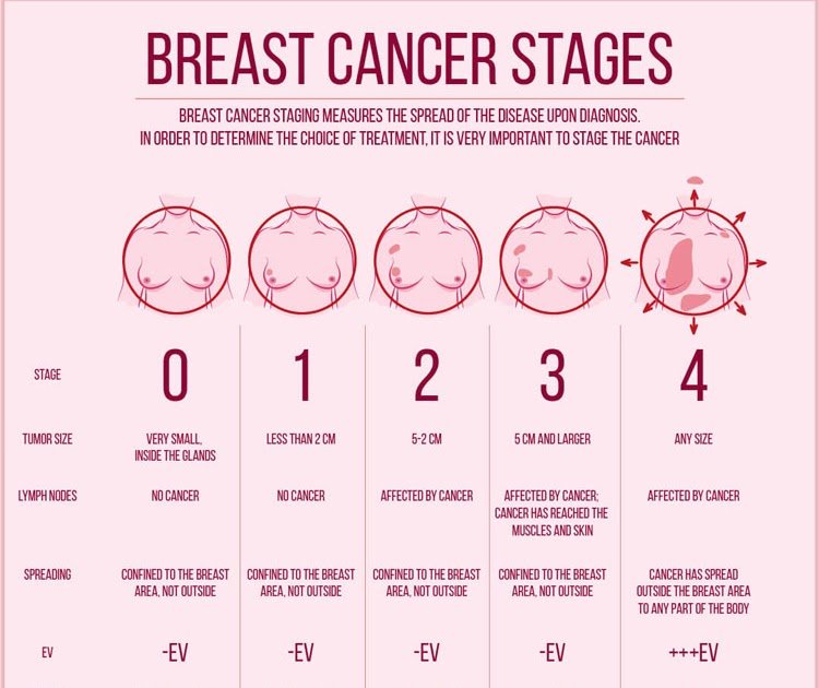 Can You Die From Stage 2 Breast Cancer ~ traiteur