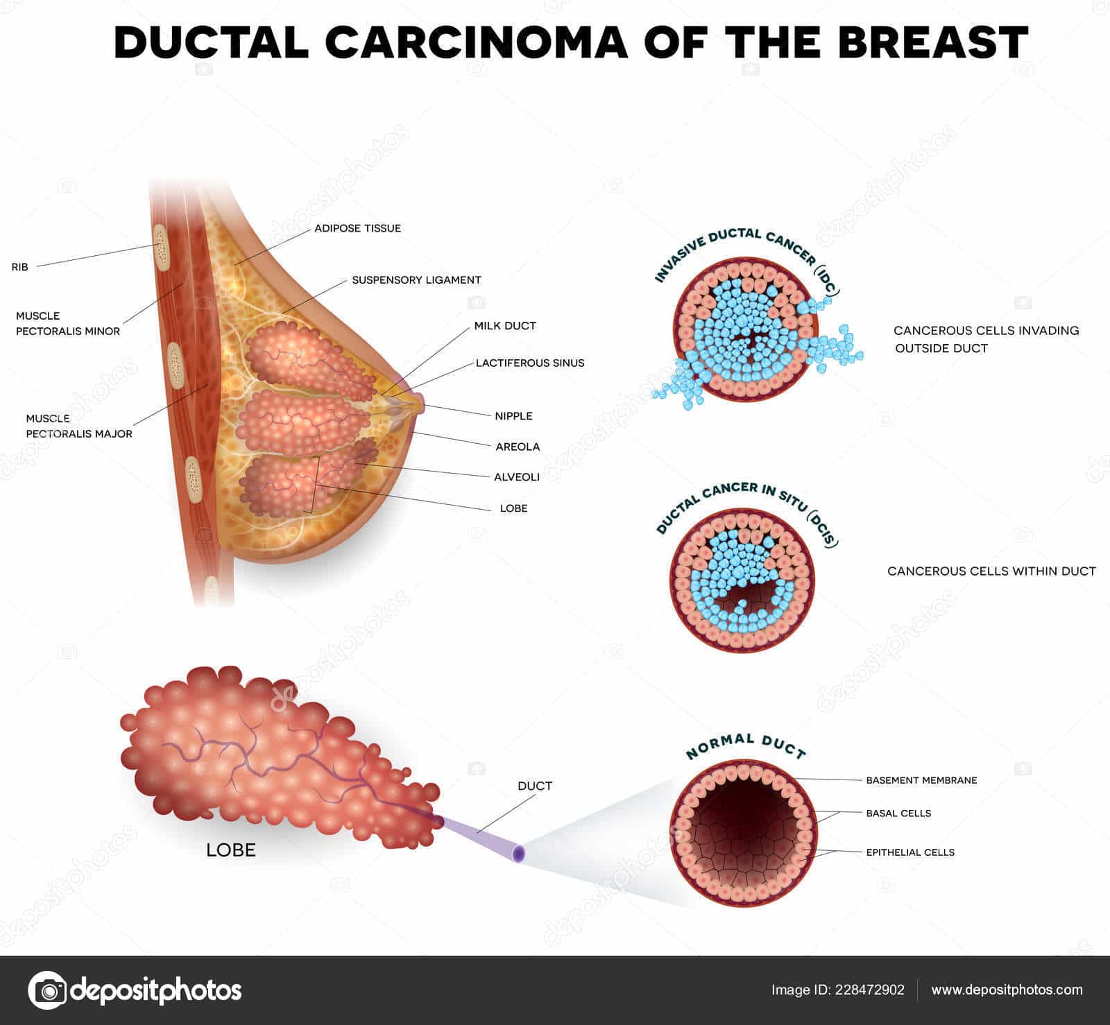Carcinoma In Situ Brust