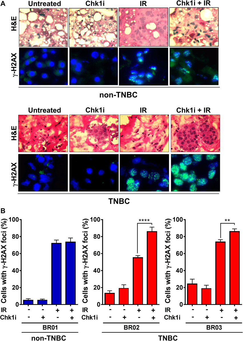 Chk1 suppresses the induction of DSB in TNBC patient tumor ...