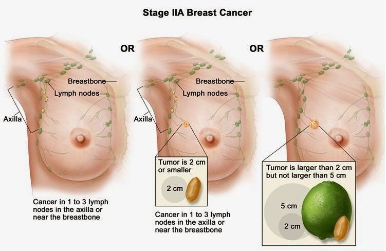 Do not despair When diagnosed with breast cancer Stage 2 ...