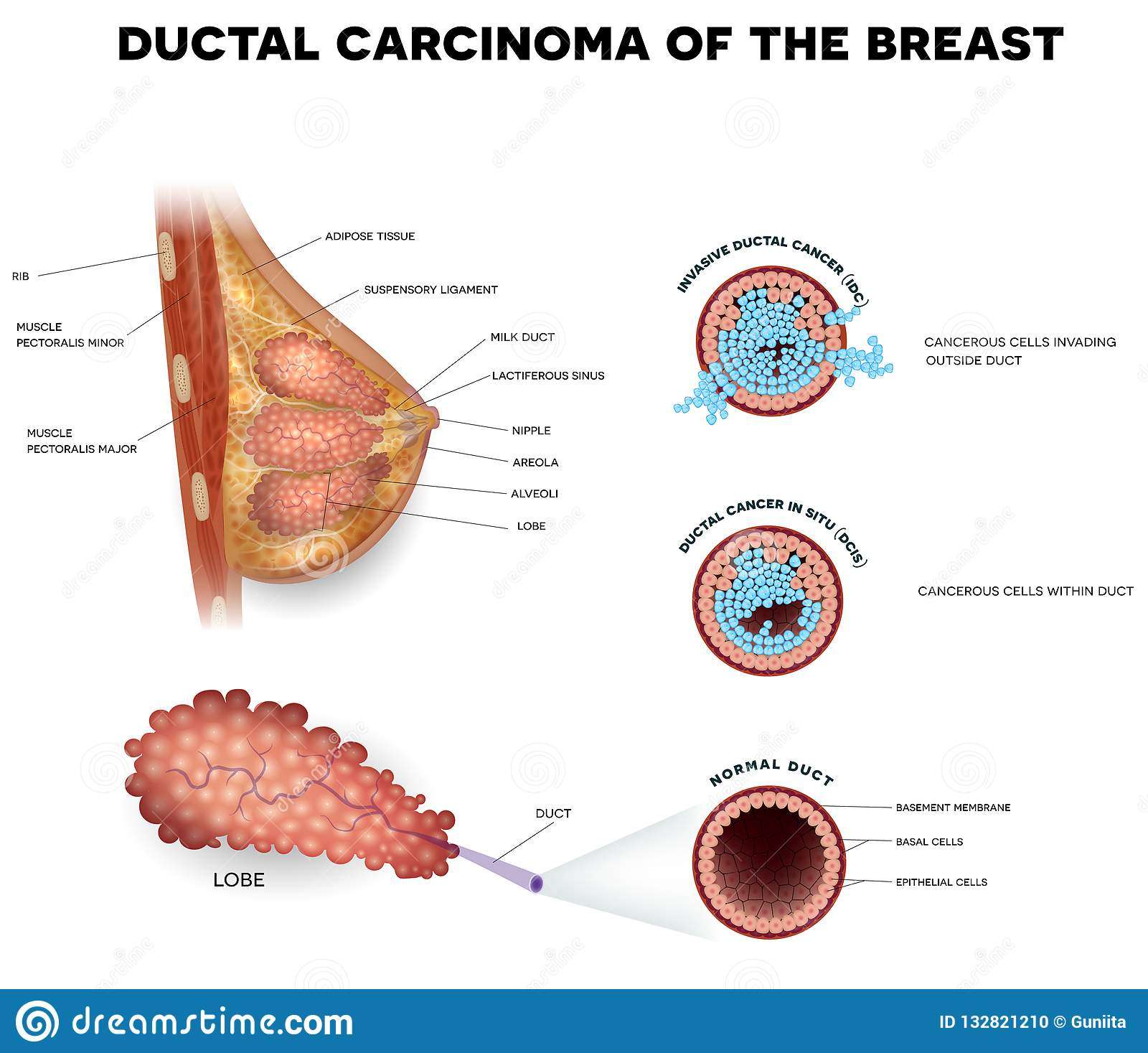Ductal cancer stock vector. Illustration of cance, glands