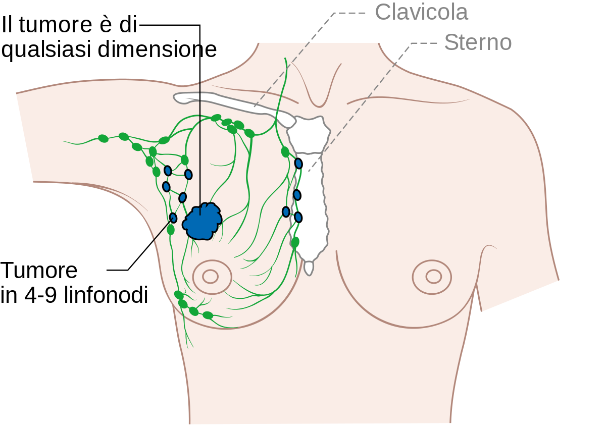 File:Diagram 1 of 3 showing stage 3A breast cancer CRUK ...