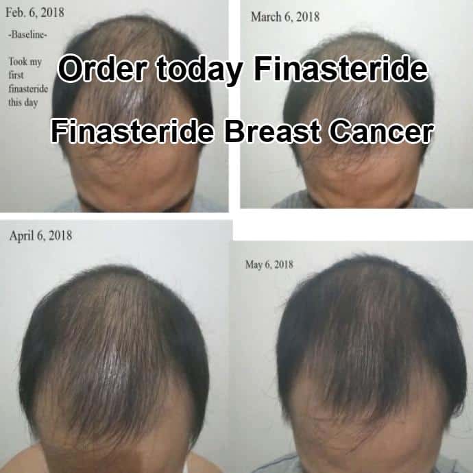 Finasteride breast cancer, finasteride breast cancer