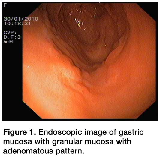 Gastric and Colon Metastasis From Breast Cancer: Case Report, Review of ...