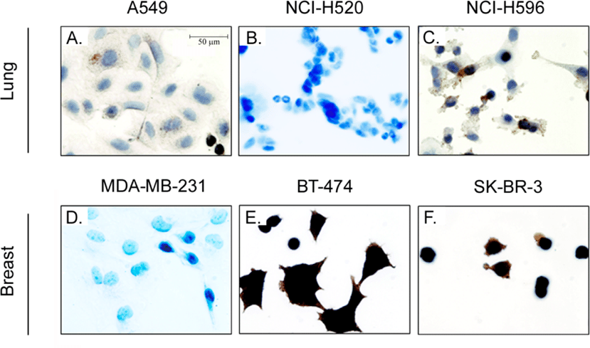 Immunohistochemical staining of HER2 biomarker in lung and ...