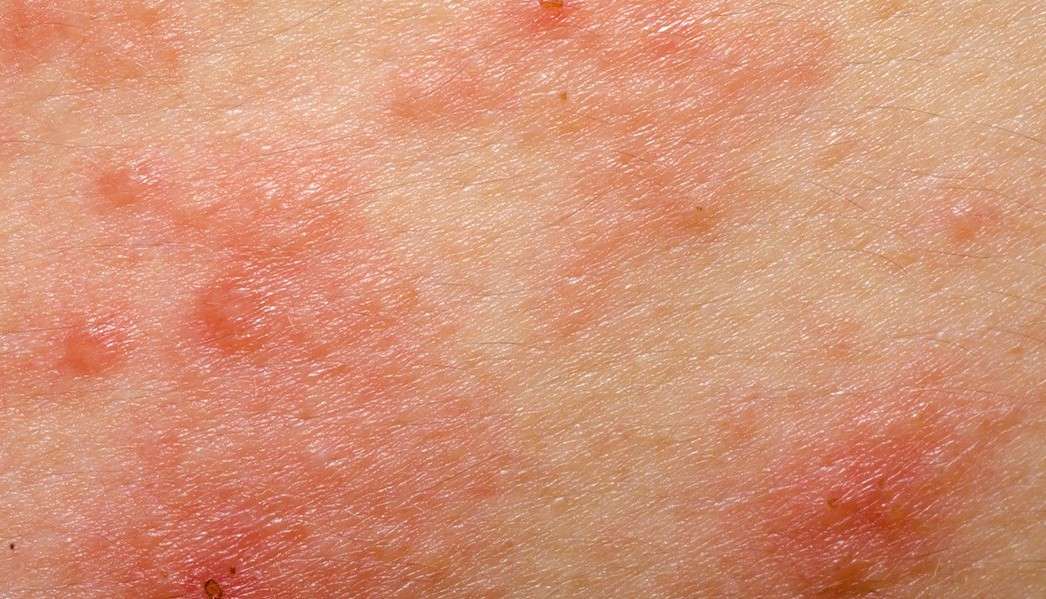 Inflammatory Breast Cancer Rash Pictures