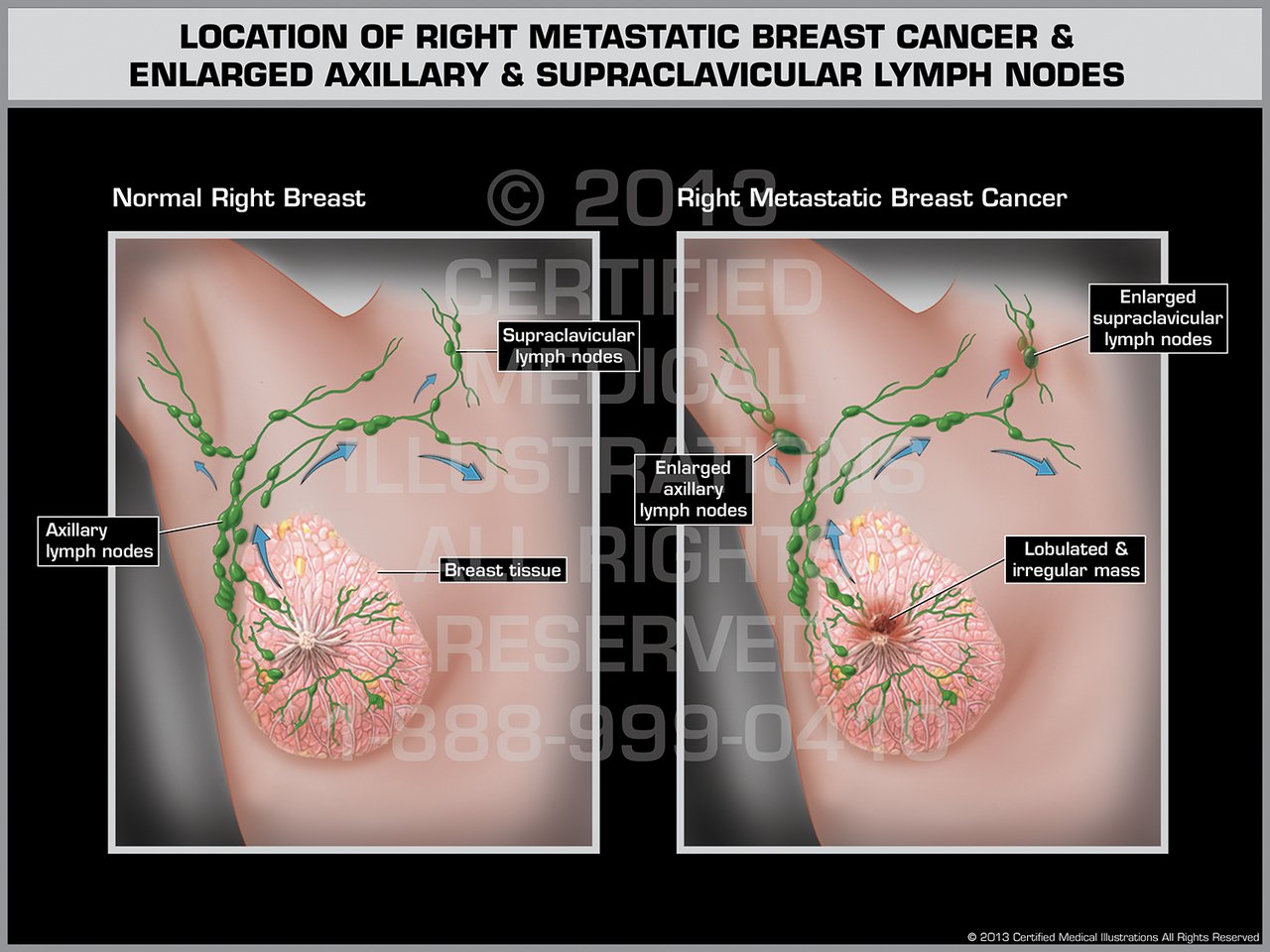 Location of Right Metastatic Breast Cancer &  Enlarged ...