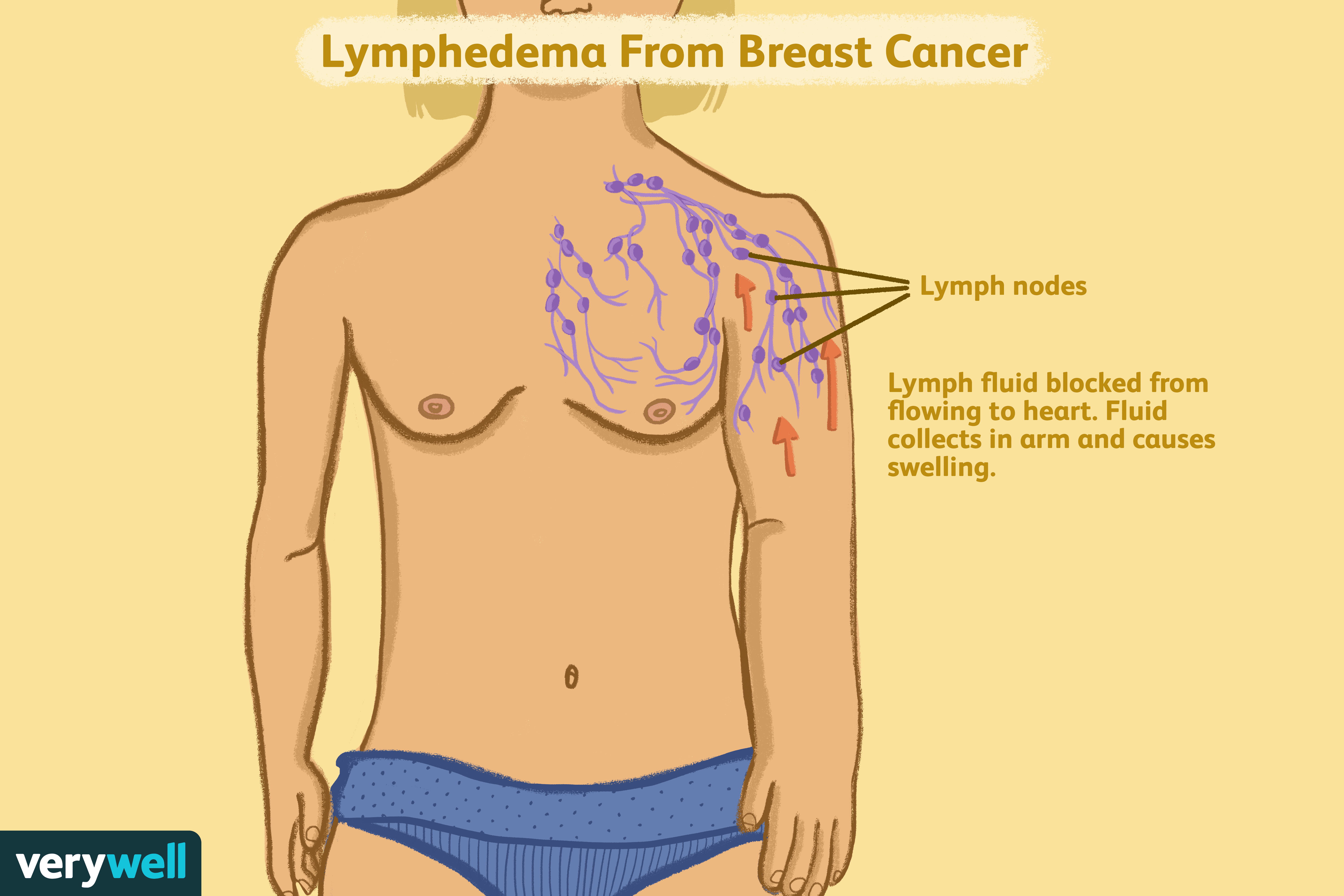Lymphedema in Breast Cancer: Symptoms, Causes, Diagnosis, and Treatment