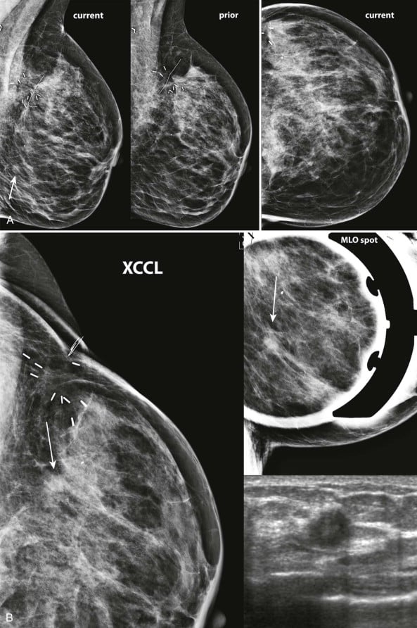 Mammographic Asymmetries