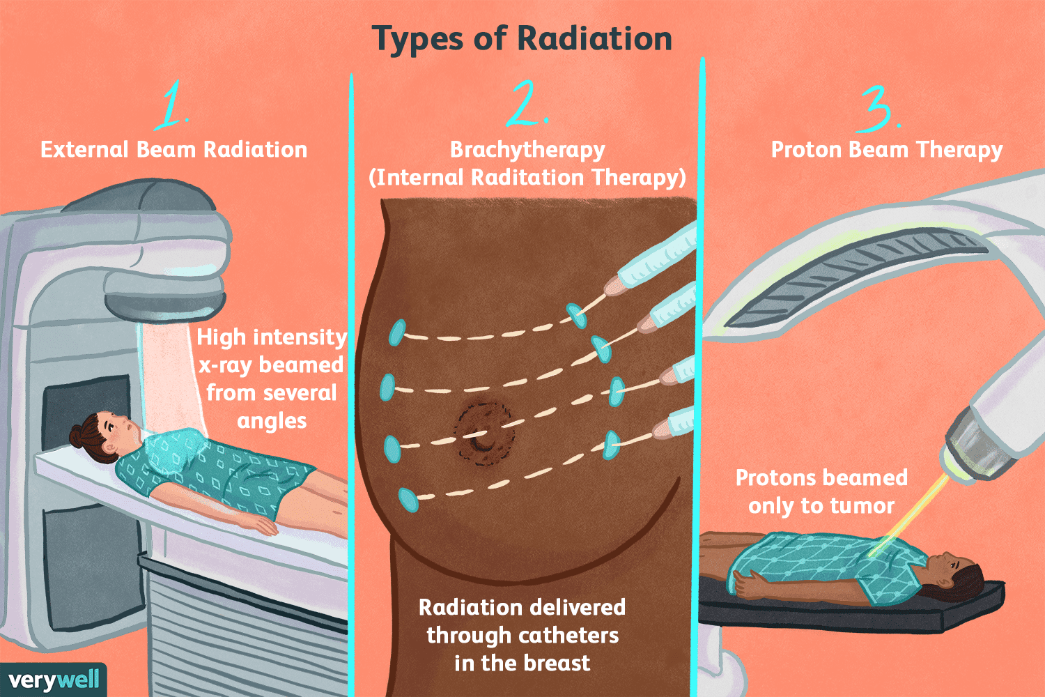 Oncology Radiation Therapy