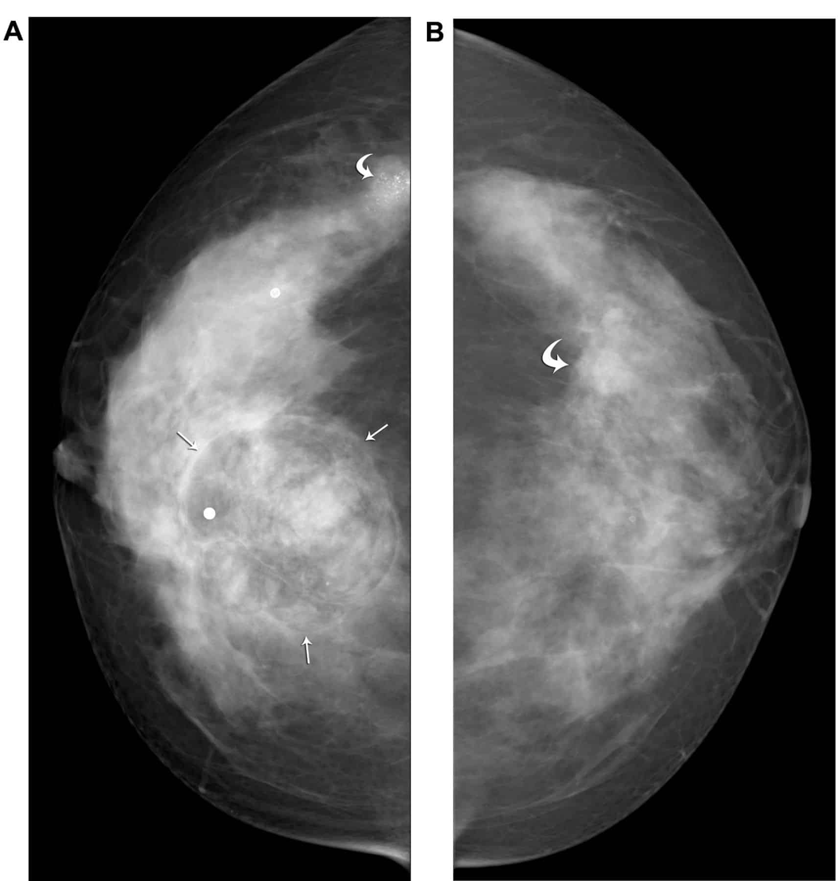 Periductal Stromal Tumor of the Breast with Synchronous Bilateral ...