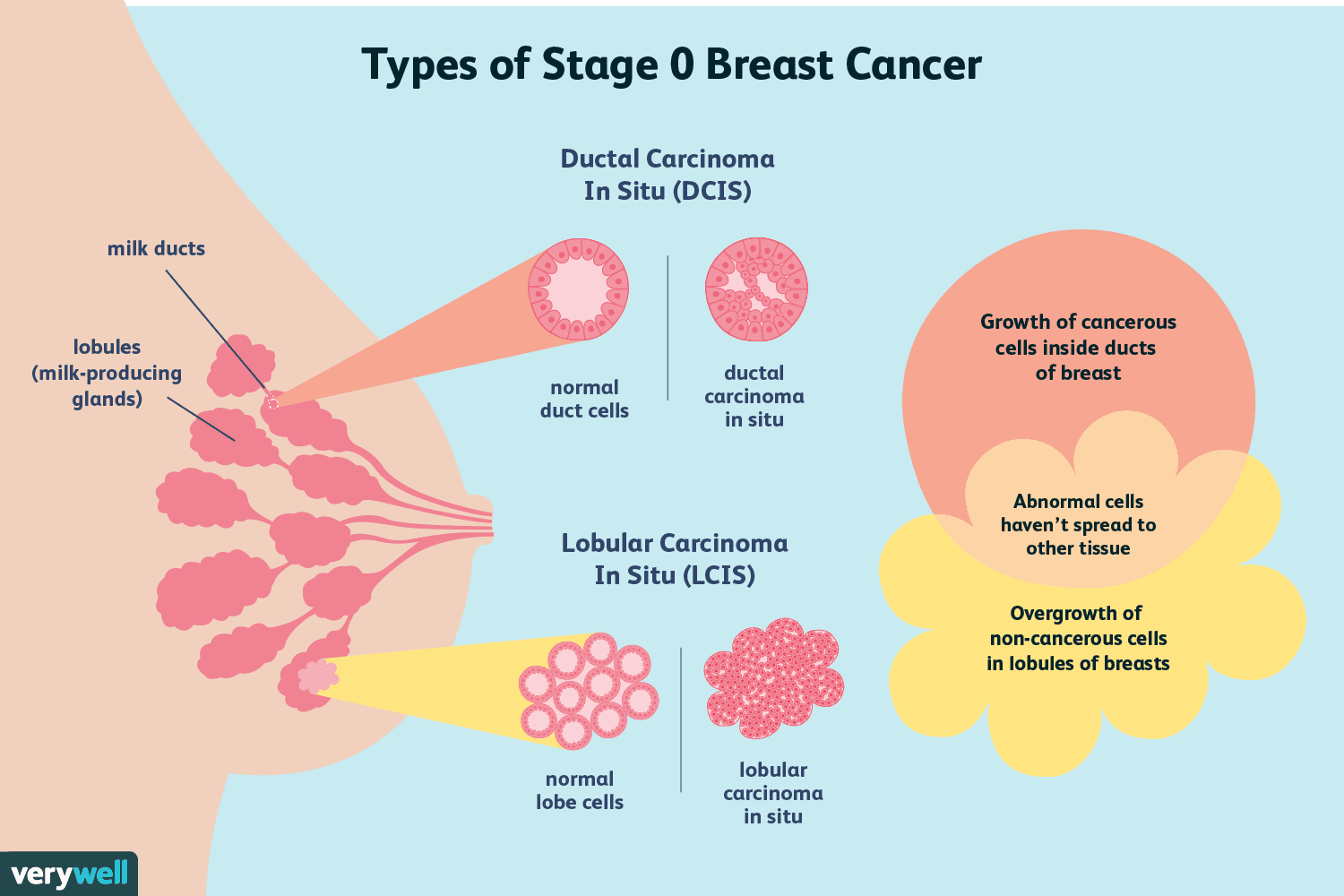 Pico question examples breast cancer