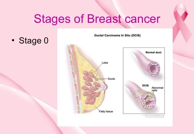 Should we screen for stage 0 Breast Cancer?