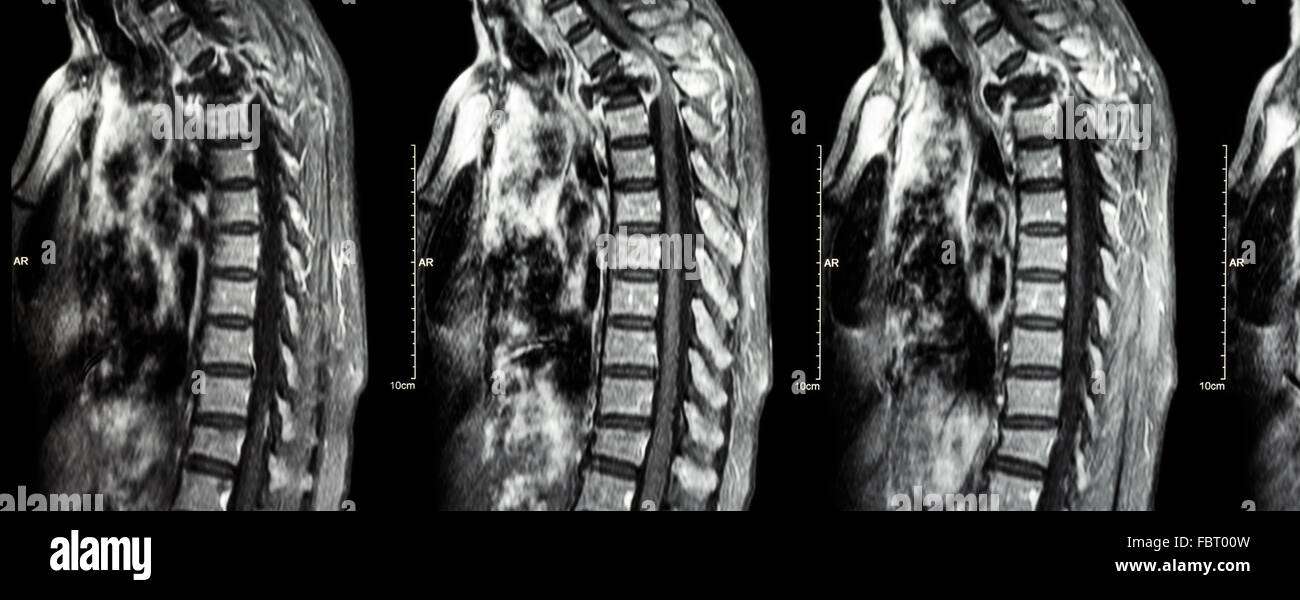 Spine metastasis ( cancer spread to thoracic spine ) ( MRI of Stock ...
