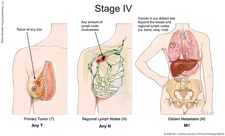 Stage 4 Breast Cancer in the Lungs