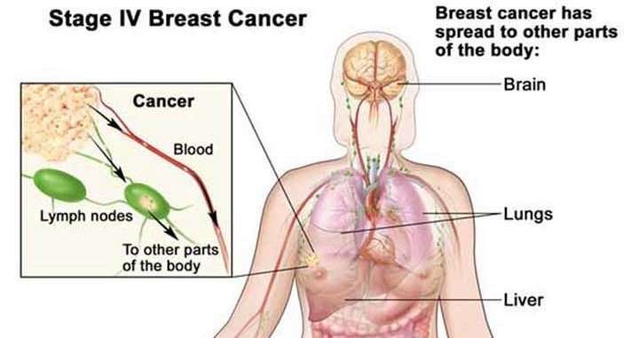 STAGE 4 BREAST CANCER RECURRENCE &  REMISSION â Medicals Plan