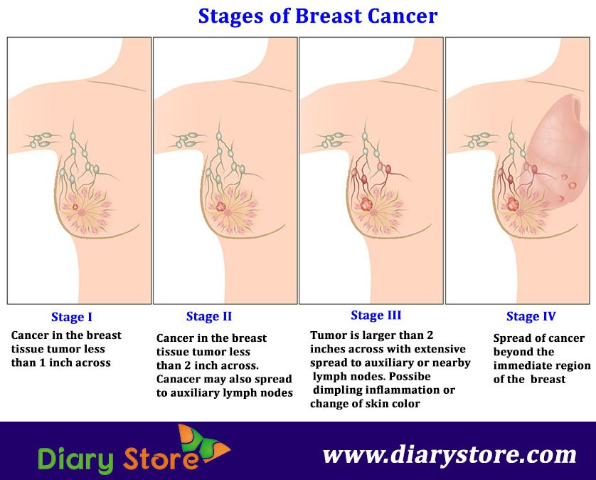 Stages Of Breast Cancer