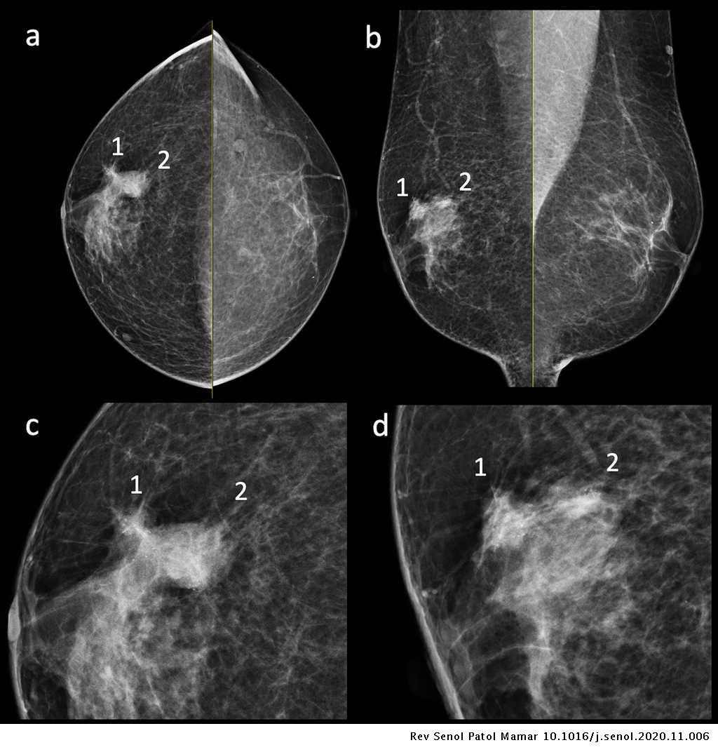 Synchronous unilateral male breast cancer presenting with ipslateral ...