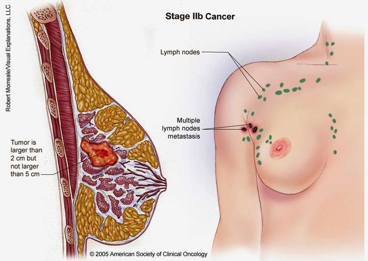 The 5 types of cancer most common in women ~ Health care ,Skin care ...