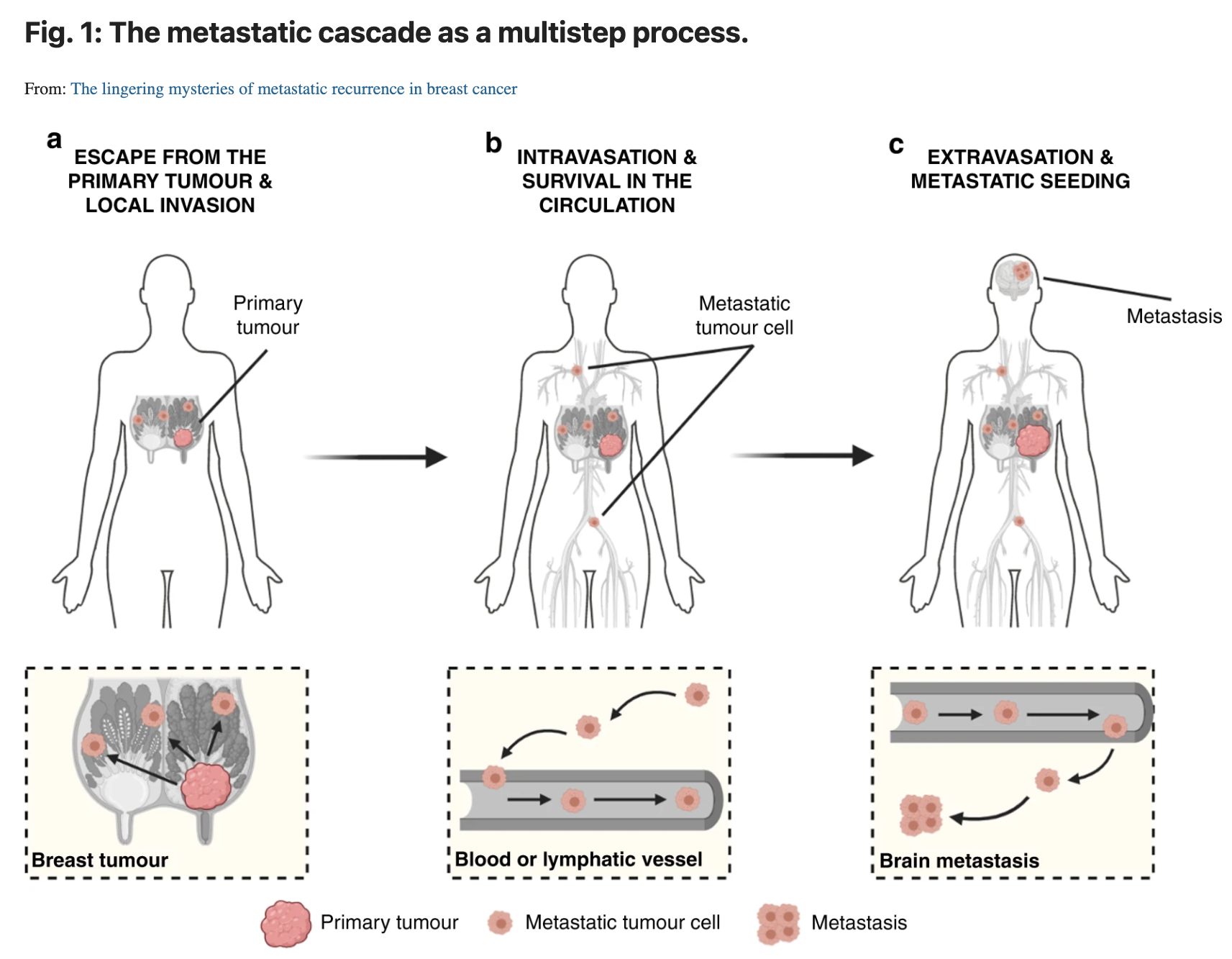 the lingering mysteries of metastatic recurrence in breast cancer in