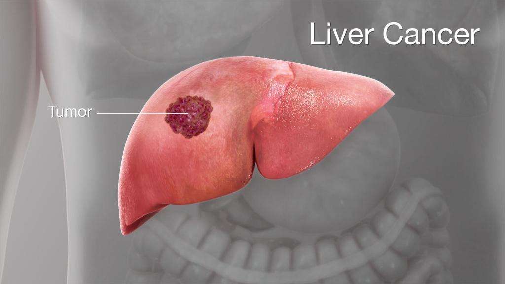 Tumors of the Liver and Biliary System