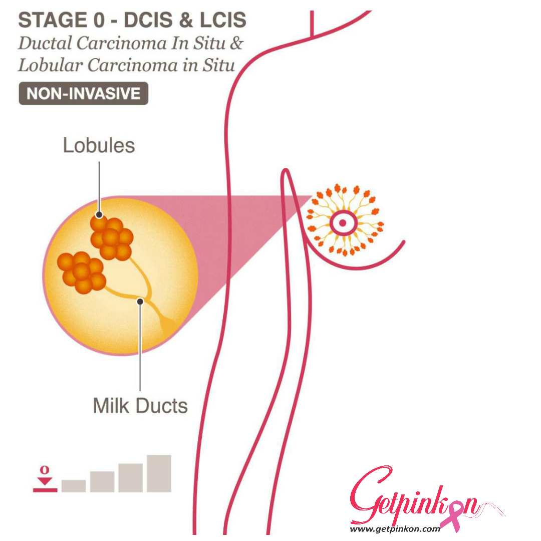 Welcome to GetPinkOn Blog: Breast Cancer Stages 0 & 1