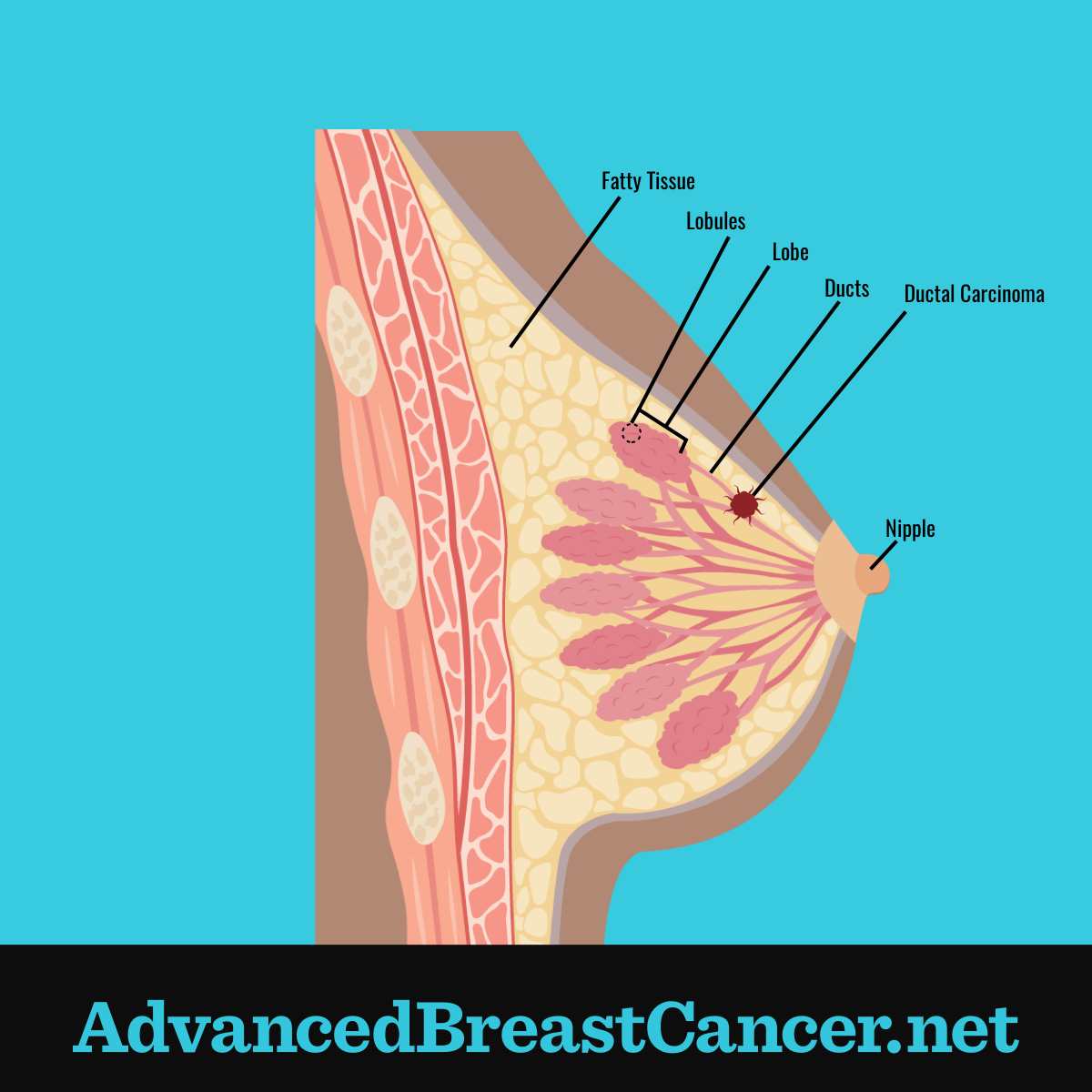 What Are the Different Types of Breast Cancer?