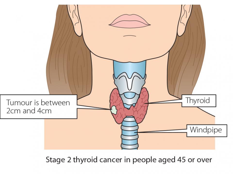 What are the grades and stages of thyroid cancer?