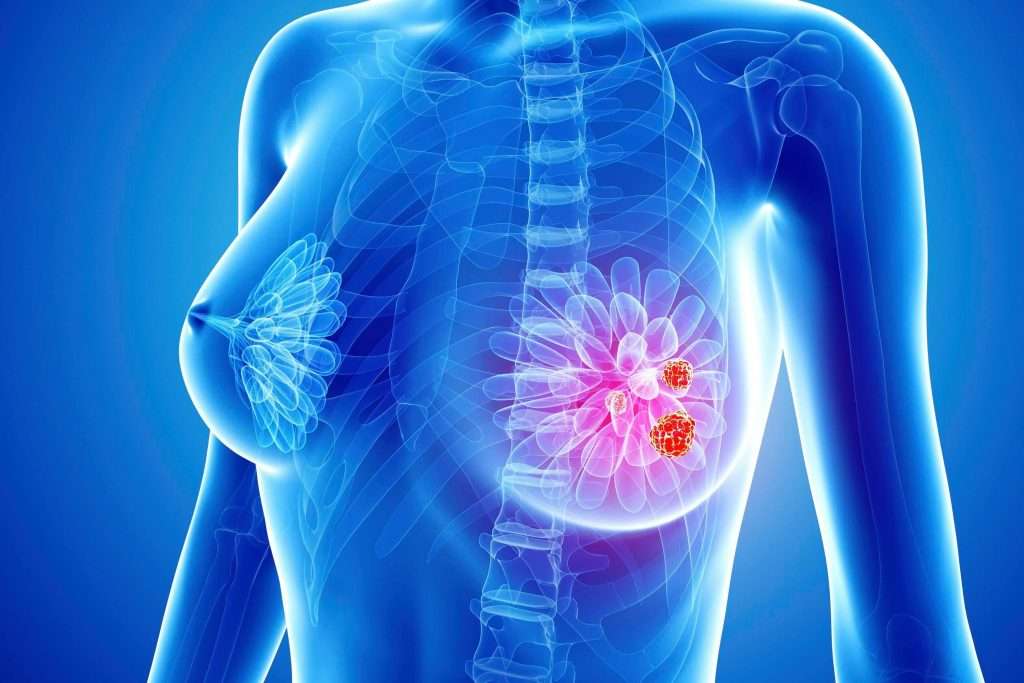 What are the symptoms of breast cancer in women, what are the stages of ...