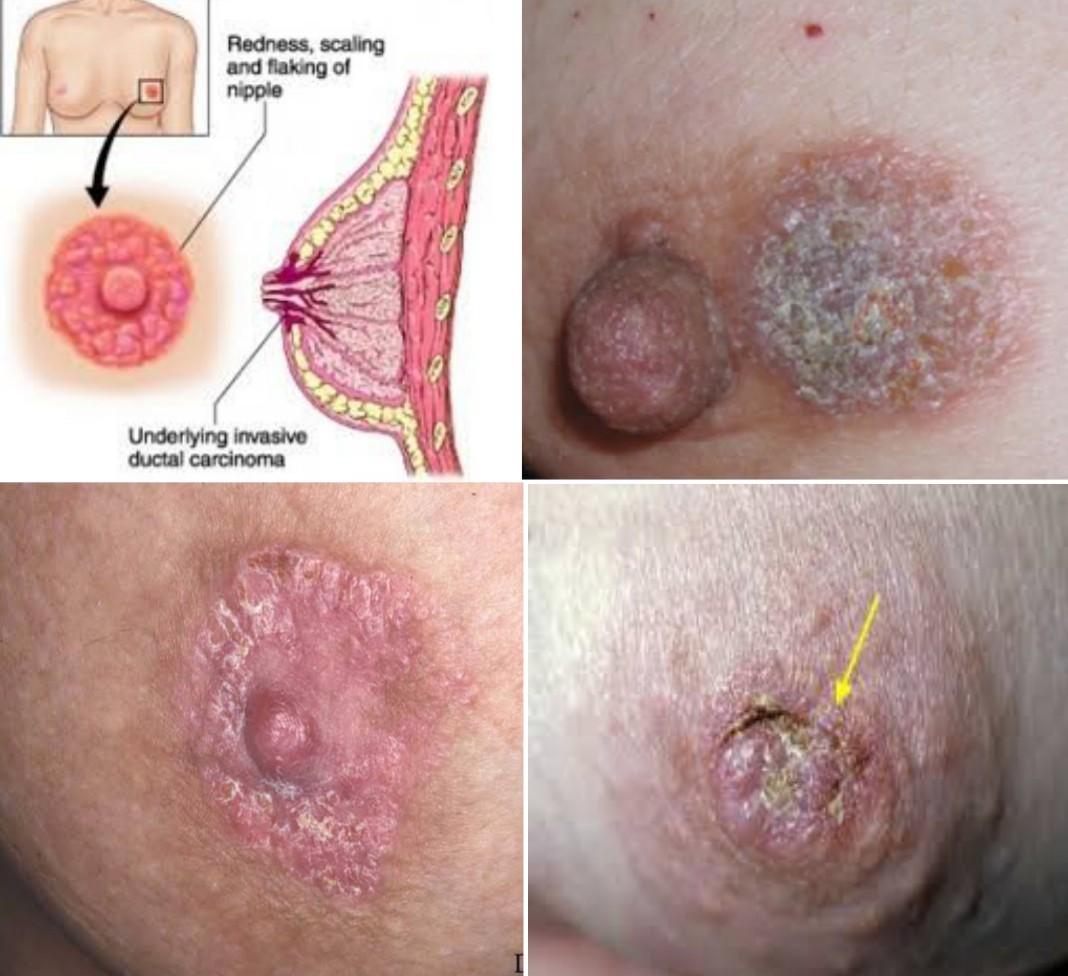 What Does A Rash From Breast Cancer Look Like
