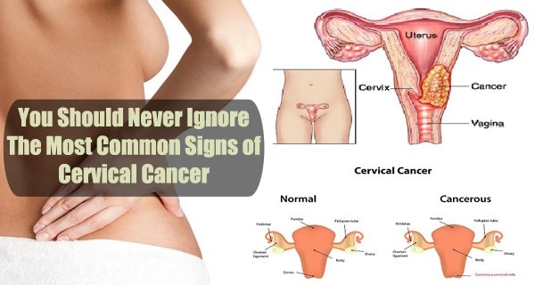 What Happens When You Have Cervical Cancer