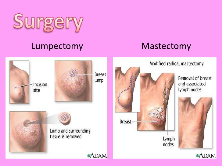 What Is Breast Cancer Lumpectomy?