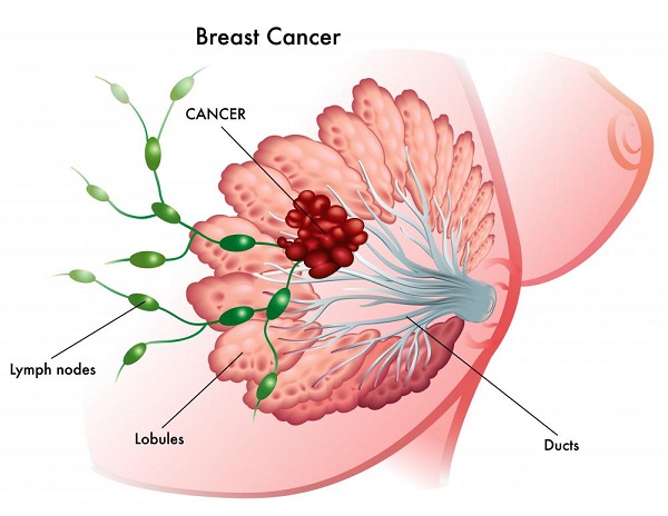 What Is Stage 3 Breast Cancer and How to Treat It?