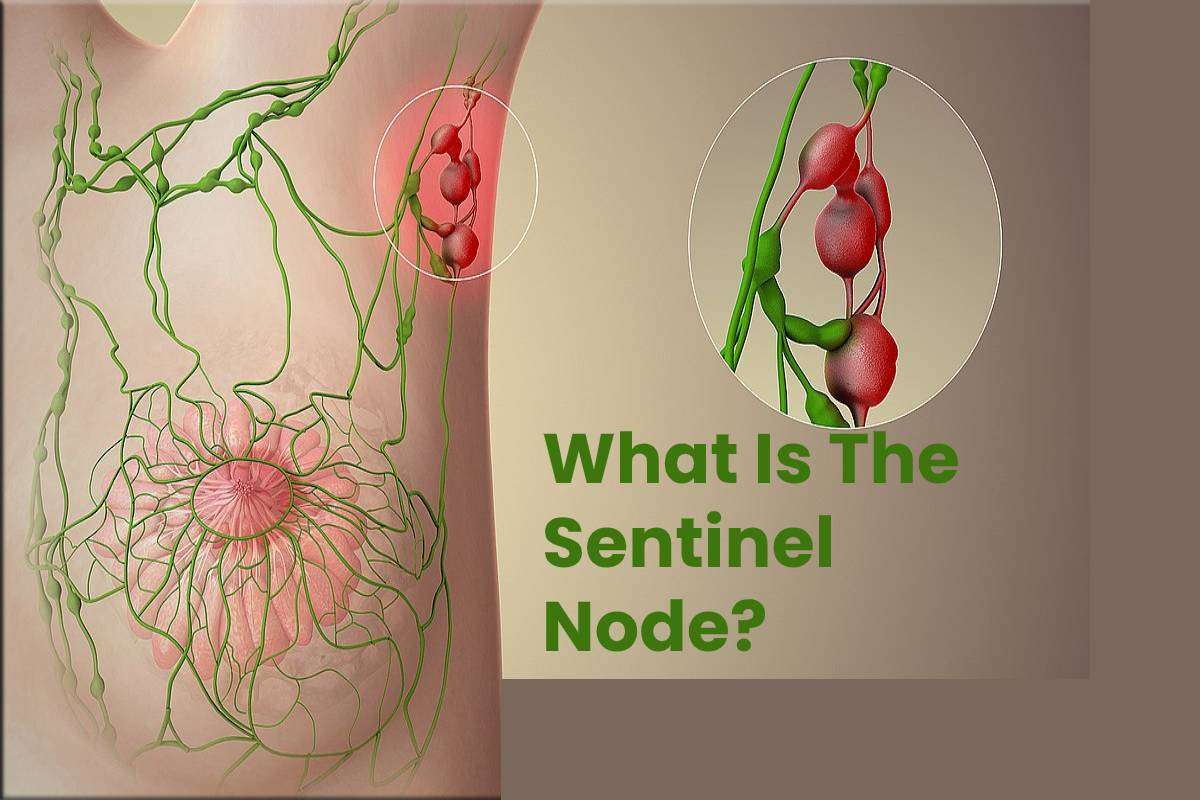 What Is The Sentinel Node?