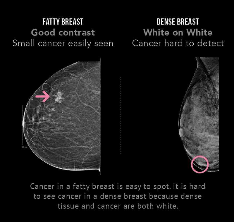 What Male Breast Cancer Looks Like
